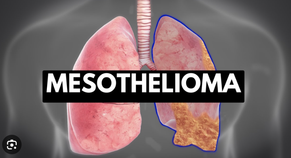 Anaheim Mesothelioma Legal Question