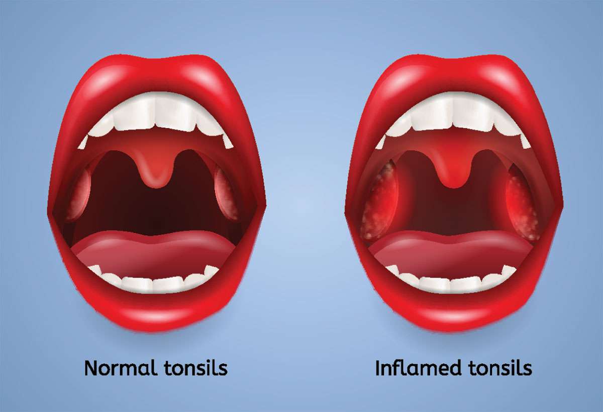 Can Tonsils Grow Back